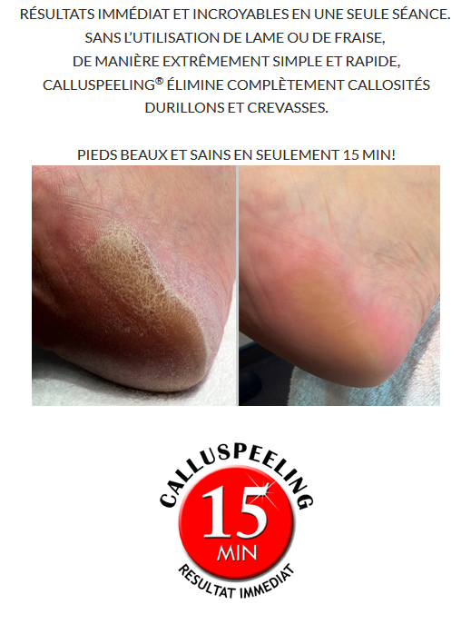 Photos de pieds avant après Soin calluspeeling de Mavex. Les callosités ont disparu après le soin d'une durée de 30 minutes.